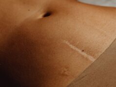 Hysterectomy through Belly Button: Revolutionary Scarless Surgery Now Available in India