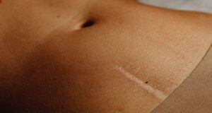 Hysterectomy through Belly Button: Revolutionary Scarless Surgery Now Available in India