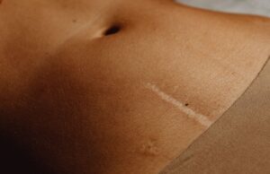 Hysterectomy through Belly Button: Revolutionary Scarless Surgery Now Available in India
