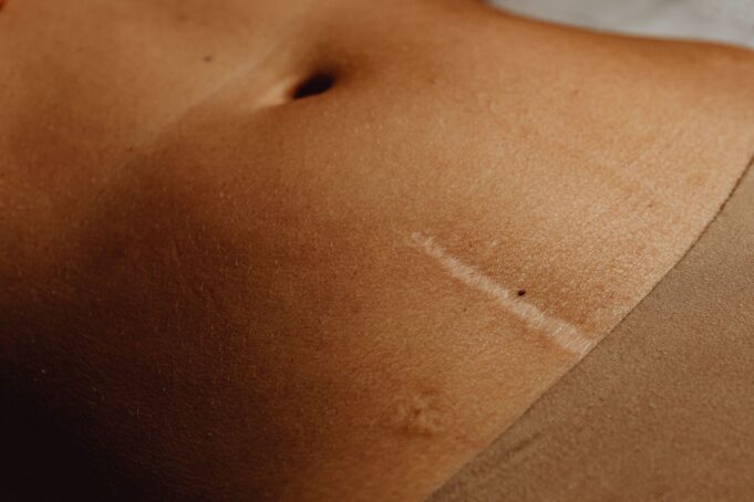 Hysterectomy through Belly Button: Revolutionary Scarless Surgery Now Available in India