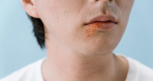 Can Kissing Spread Herpes? What Indians Need to Know About This Common STI