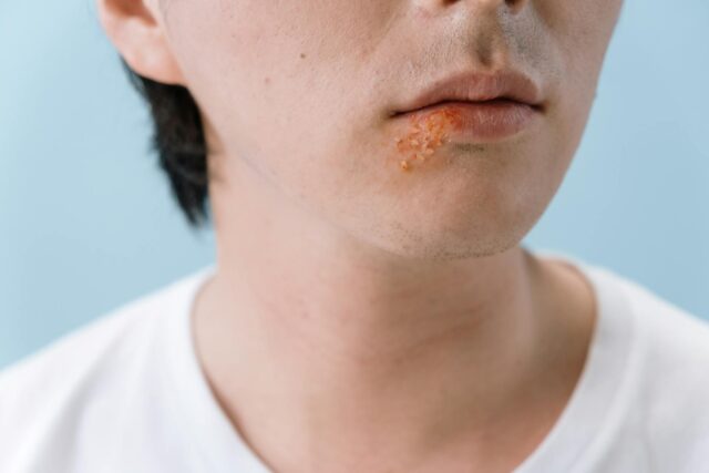 kissing-herpes-transmission-india-health
