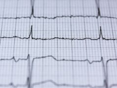 Woman Successfully Treated for Recurrent Heart Rhythm Disorder at Apollo Hospitals Chennai