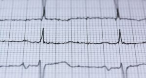 Woman Successfully Treated for Recurrent Heart Rhythm Disorder at Apollo Hospitals Chennai