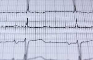 Woman Successfully Treated for Recurrent Heart Rhythm Disorder at Apollo Hospitals Chennai