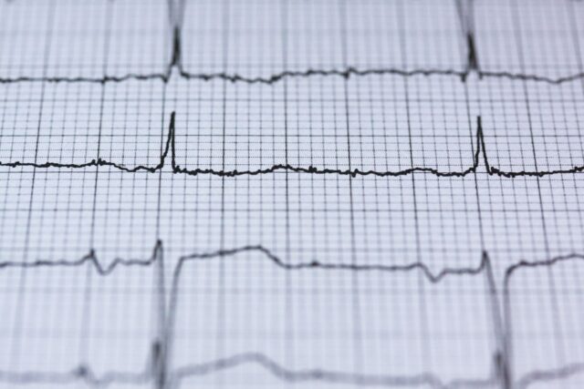 woman-heart-rhythm-disorder-apollo-hospitals-chennai