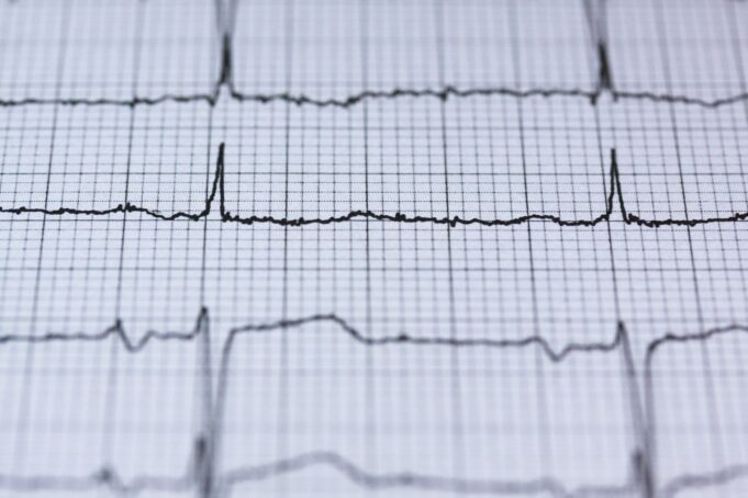 Woman Successfully Treated for Recurrent Heart Rhythm Disorder at Apollo Hospitals Chennai